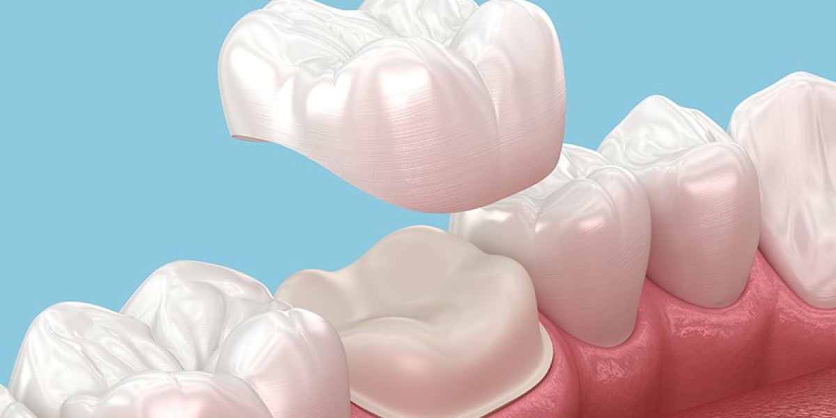 Dental Crowns & Bridges Dubai – Smile Stronger