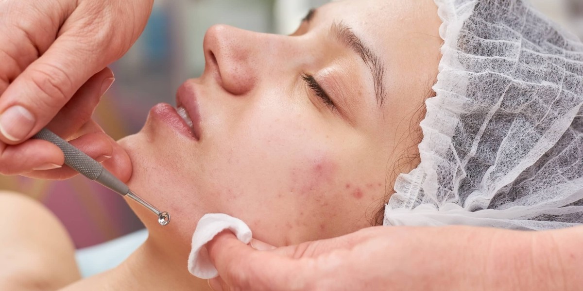 Pimples Treatment in Islamabad Clinics with Modern Technology