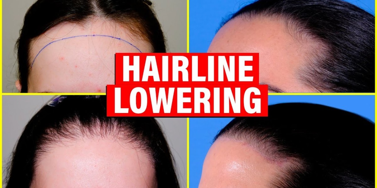 From Thinning to Thriving: How Modern Hair Replacement Systems Boost Confidence