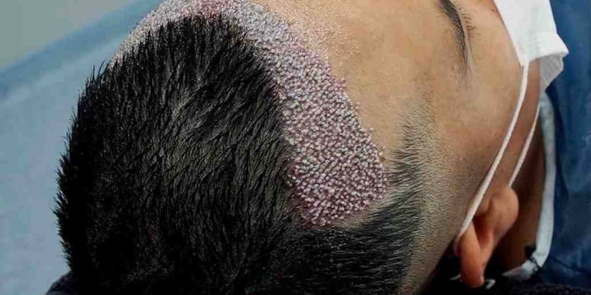 FUE Hair Transplant in Islamabad: Recovery and Aftercare